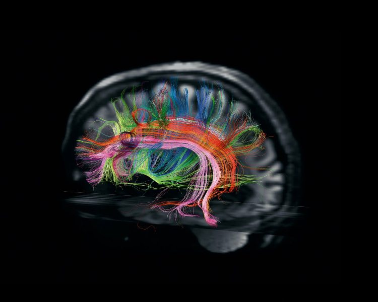 Cerebro 1